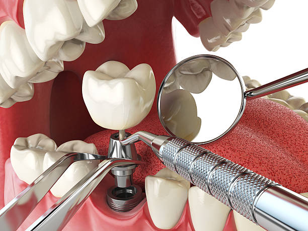 Best Emergency Root Canal Treatment in Middle Valley, TN
